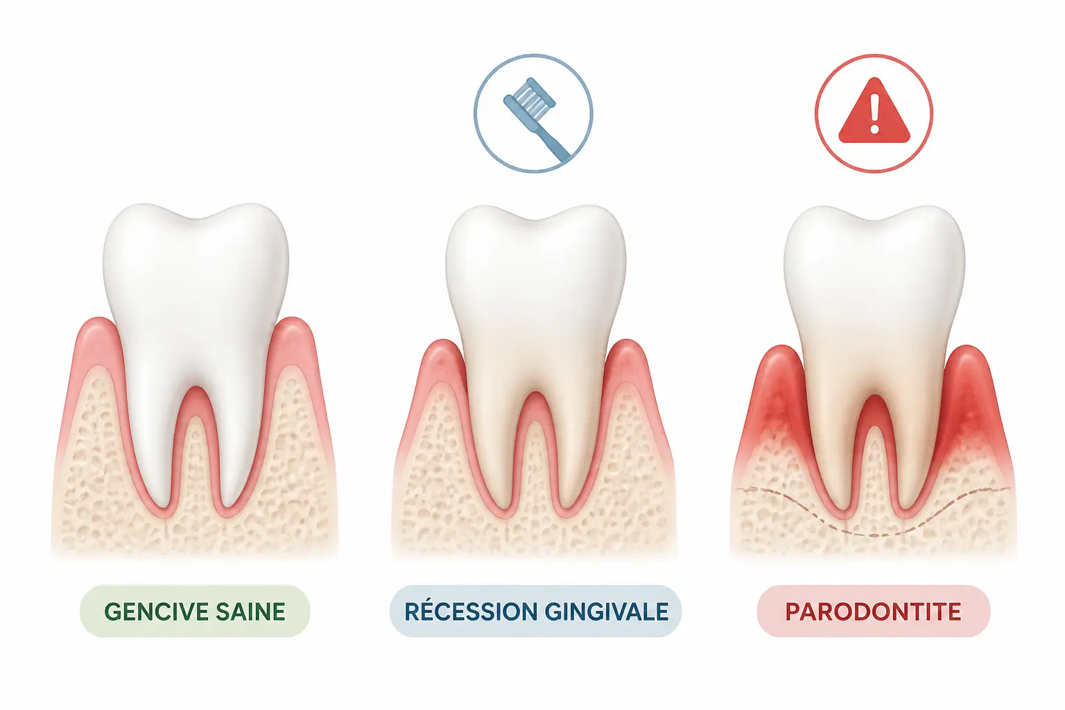 Déchaussement dentaire, récession gingivale, gingivite, parodontite : ce qui change vraiment