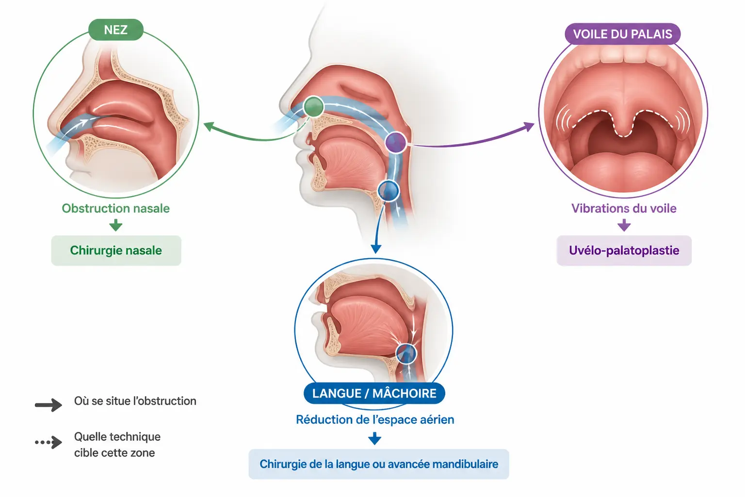 Quelles techniques existent et laquelle correspond à votre cause