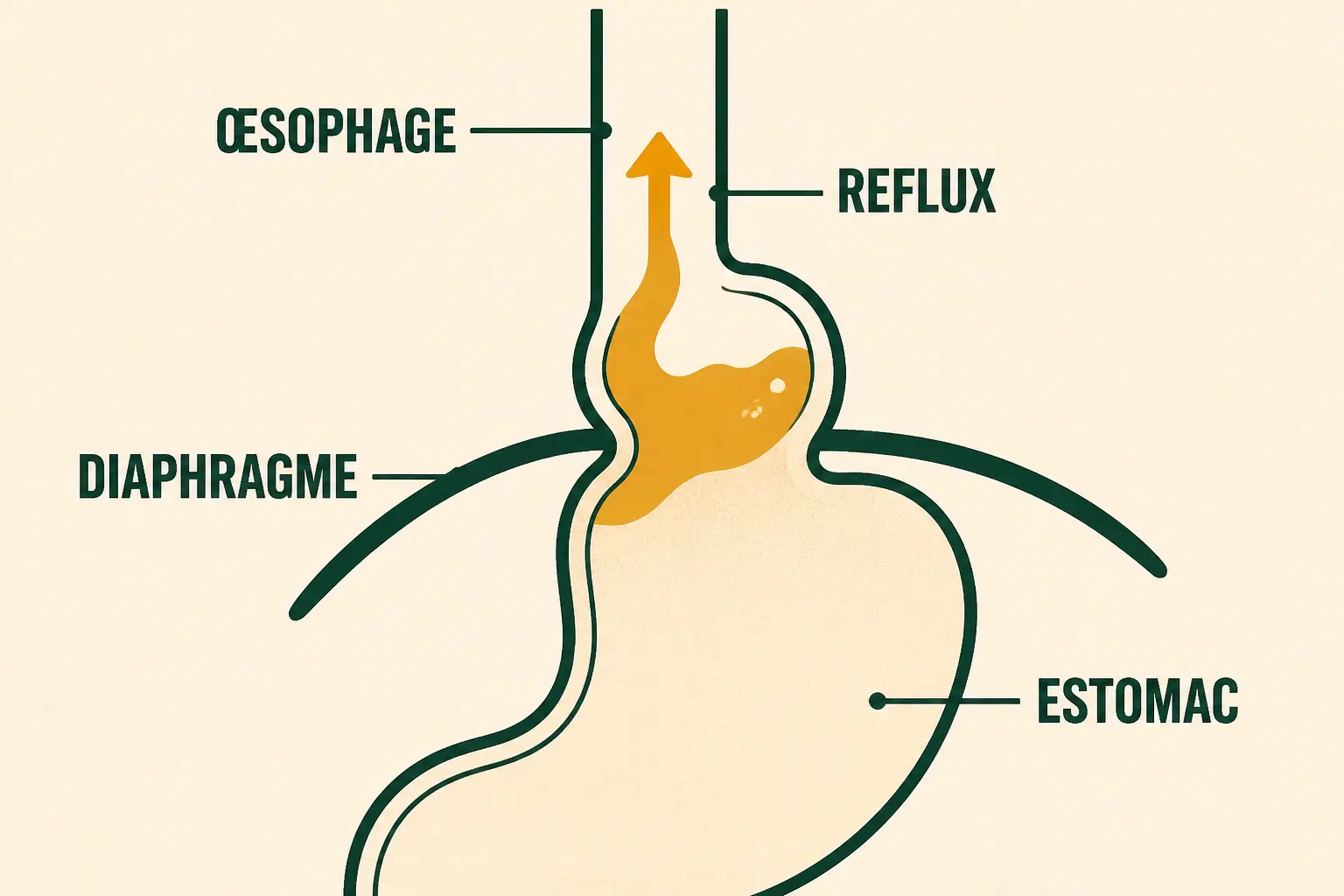 Hernie hiatale remède de grand-mère : schéma minimal du diaphragme, de l’estomac et du reflux.